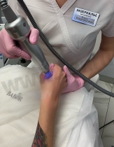 Процесс проведения процедуры игольчатого RF-лифтинга на аппарате SCARLET-F (кисти рук)